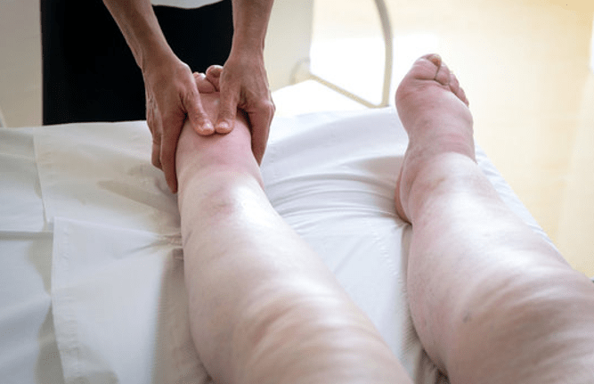 Edema