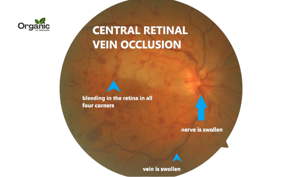 Retinal Vein Occlusion Allwellhealthorganic (1)