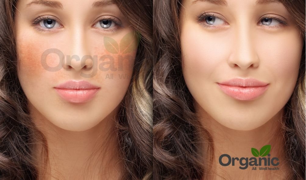 Well health organic best ways to remove dark spots on face