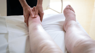 Edema