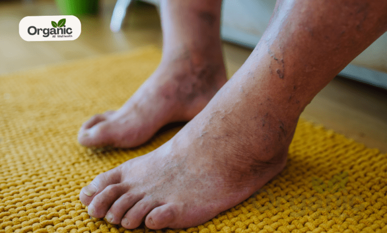 Diabetes Symptoms in Legs All Wellhealthorganic