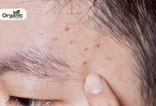Eyebrow Acne