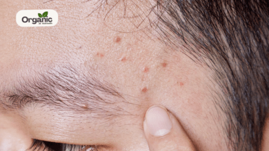 Eyebrow Acne