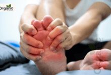 High Uric Acid