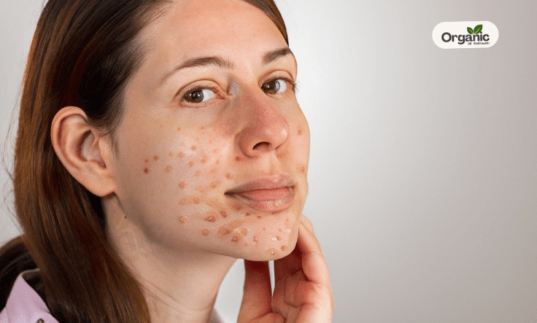 Aspirin Could Lower Skin Cancer Risk Allwellhealthorganic