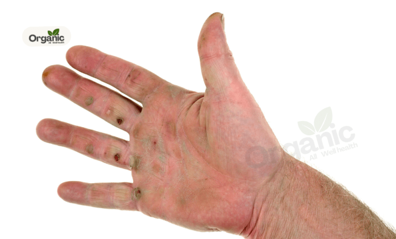 Got a blood blister 5 effective home remedies to get rid of the ugly looking bump Allwellhealthorganic