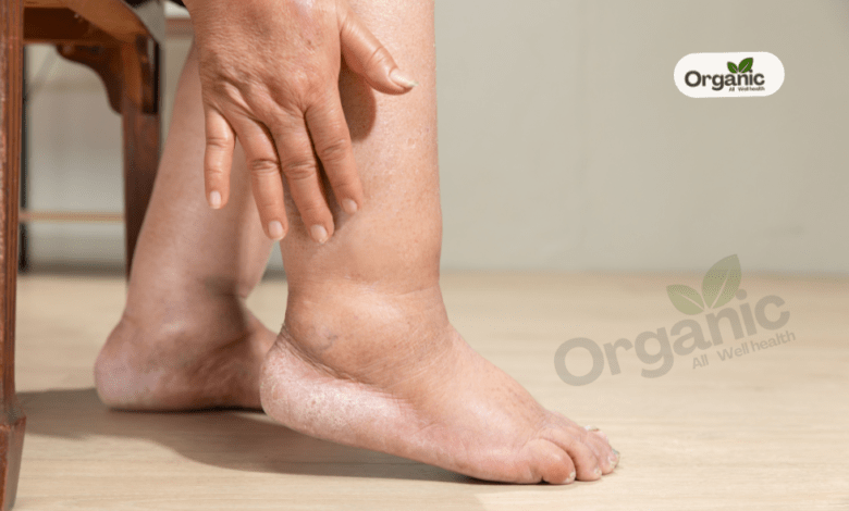Home Remedies To Treat Swollen Feet Allwellhealthorganic
