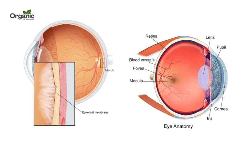 Epiretinal Membrane क्या है Allwellhealthorganic
