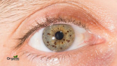 Eye Freckles Allwellhealthorganic