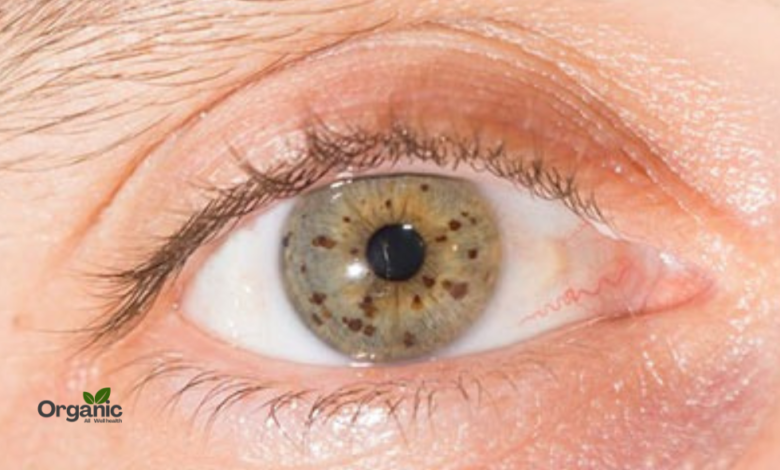 Eye Freckles Allwellhealthorganic