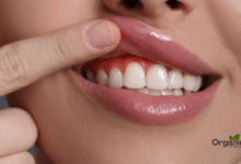 Gum disease Allwellhealthorganic