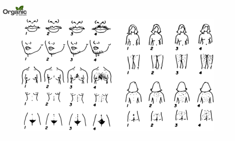 Hirsutism Allwellhealthorganic