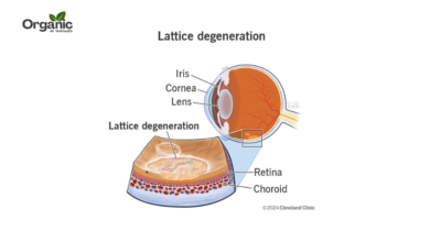 Lattice Degeneration क्या है Allwellhealthorganic