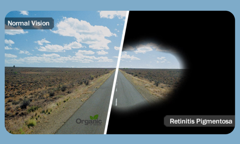 Retinitis Pigmentosa क्या है Allwellhealthorganic