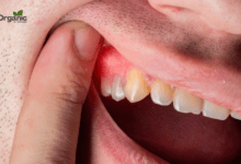 Stages of Gum Disease Allwellhealthorganic