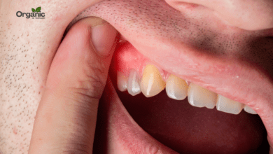 Stages of Gum Disease Allwellhealthorganic