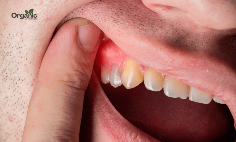 Stages of Gum Disease Allwellhealthorganic