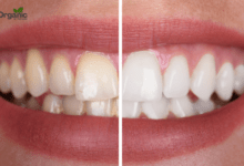 Teeth whitening Allwellhealthorganic