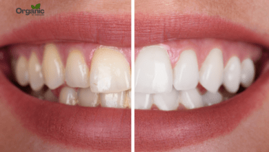 Teeth whitening Allwellhealthorganic