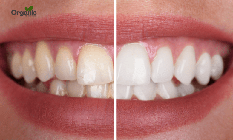 Teeth whitening Allwellhealthorganic