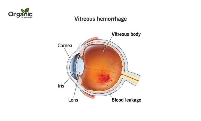 Vitreous Hemorrhage क्या है Allwellhealthorganic