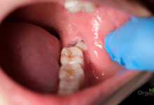 Wisdom Teeth अक्ल दाढ़ क्यों निकलवानी पड़ती है लक्षण, इलाज और बचाव Allwellhealthorganic