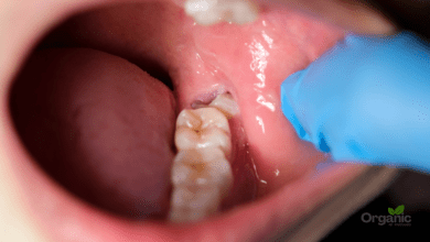 Wisdom Teeth अक्ल दाढ़ क्यों निकलवानी पड़ती है लक्षण, इलाज और बचाव Allwellhealthorganic