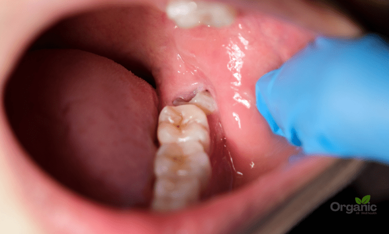 Wisdom Teeth अक्ल दाढ़ क्यों निकलवानी पड़ती है लक्षण, इलाज और बचाव Allwellhealthorganic