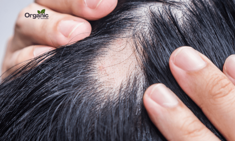 Alopecia Areata Allwellhealthorganic