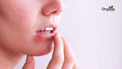 Cold Sores Allwellhealthorganic