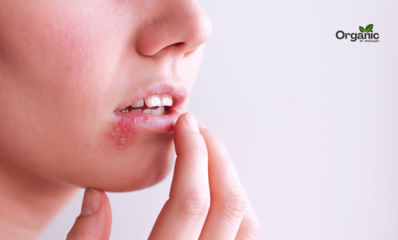 Cold Sores Allwellhealthorganic