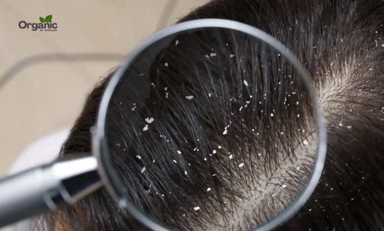 Dandruff (डैंड्रफ) कारण, लक्षण, प्रकार, इलाज और बचाव की पूरी जानकारी Allwellhealthorganic