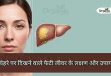 Fatty Liver Symptoms on the Face Allwellhealthorganic