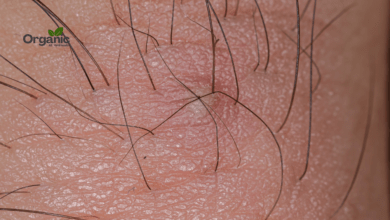 Ingrown Hair Allwellhealthorganic