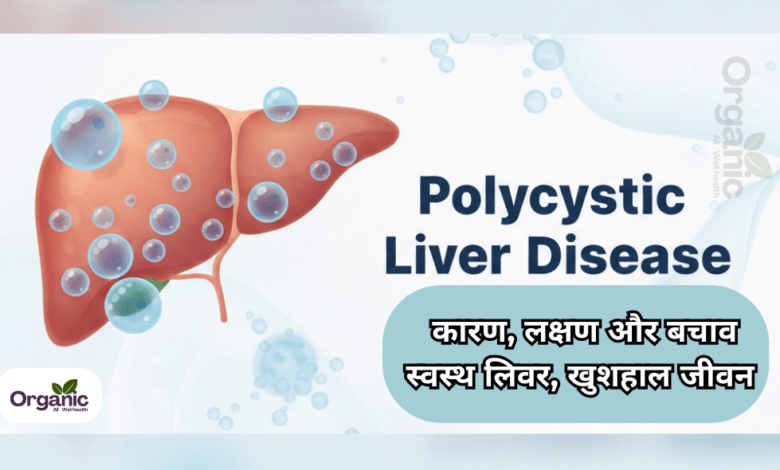 Polycystic Liver Disease Healthy life Wellhealthorganic Allwellhealthorganic Lifestyle