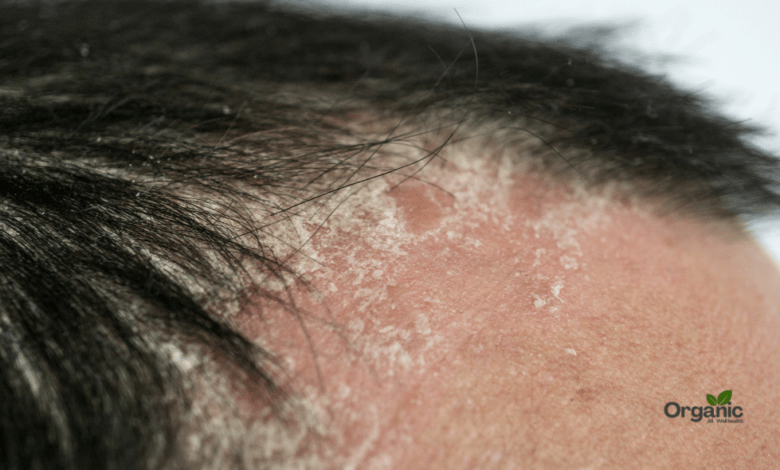 Scalp Psoriasis Allwellhealthorganic