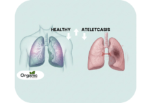 Atelectasis Allwellhealthorganic