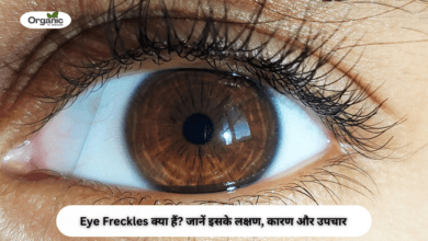 Eye Freckles Allwellhealthorhanic.com wellhealthorganic.com Best Health tips Health Tips