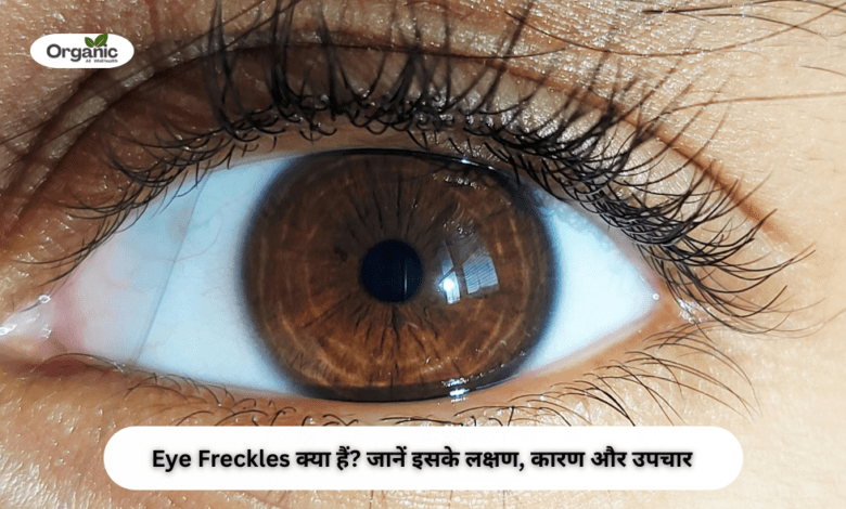 Eye Freckles Allwellhealthorhanic.com wellhealthorganic.com Best Health tips Health Tips