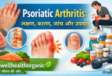 Psoriatic Arthritis Allwellhealthorhanic.com wellhealthorganic.com Best Health tips Health Tips