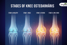 Stages of Knee Osteoarthritis Allwellhealthorganic