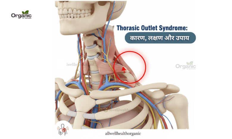 Thoracic Outlet Syndrome Allwellhealthorganic