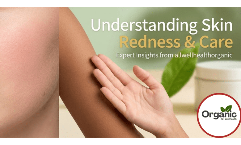 Causes of Redness on Skin Allwellhealthorhanic.com wellhealthorganic.com Best Health tips Health Tips