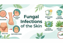 Fungal Infections of the Skin Allwellhealthorhanic.com wellhealthorganic.com Best Health tips Health Tips