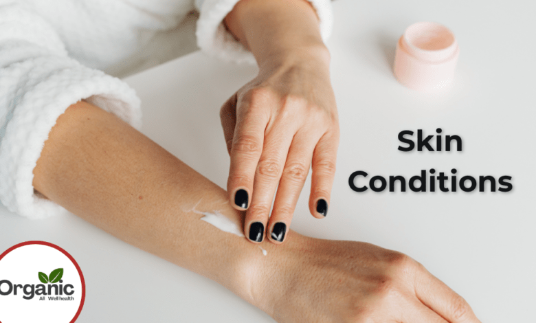 Skin Conditions Allwellhealthorhanic.com wellhealthorganic.com Best Health tips Health Tips