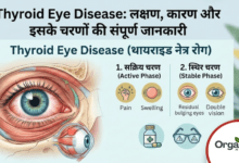 Thyroid Eye Disease