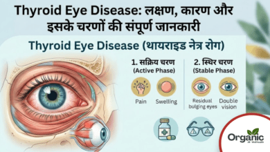 Thyroid Eye Disease