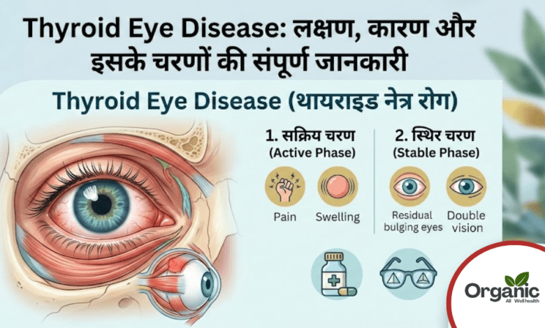 Thyroid Eye Disease