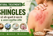 Natural Treatments for Shingles