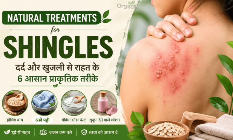 Natural Treatments for Shingles